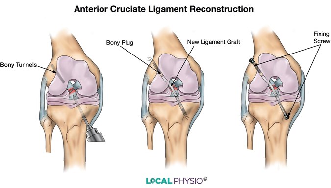 acl physical therapy assessment