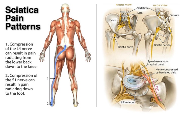 Sciatica Local Physio Local Physio