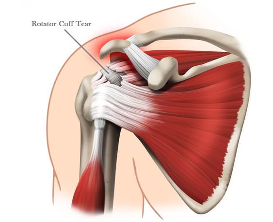 Rotator Cuff Injury Local Physio