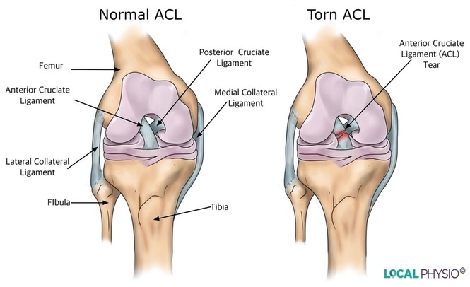 Anterior Cruciate Ligament (ACL) & Medial Collateral Knee Ligament