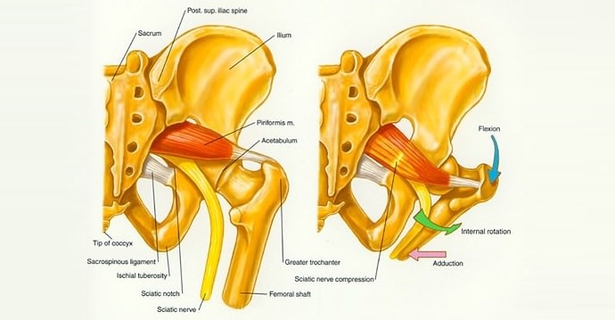 Pain in the butt - Why It's not Piriformis Syndrome