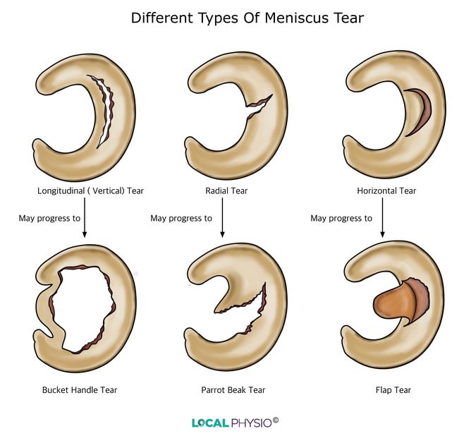 Meniscus Tear | Local Physio