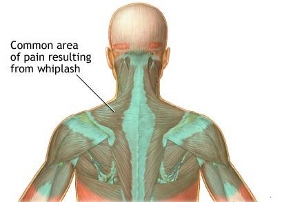 Whiplash Local Physio