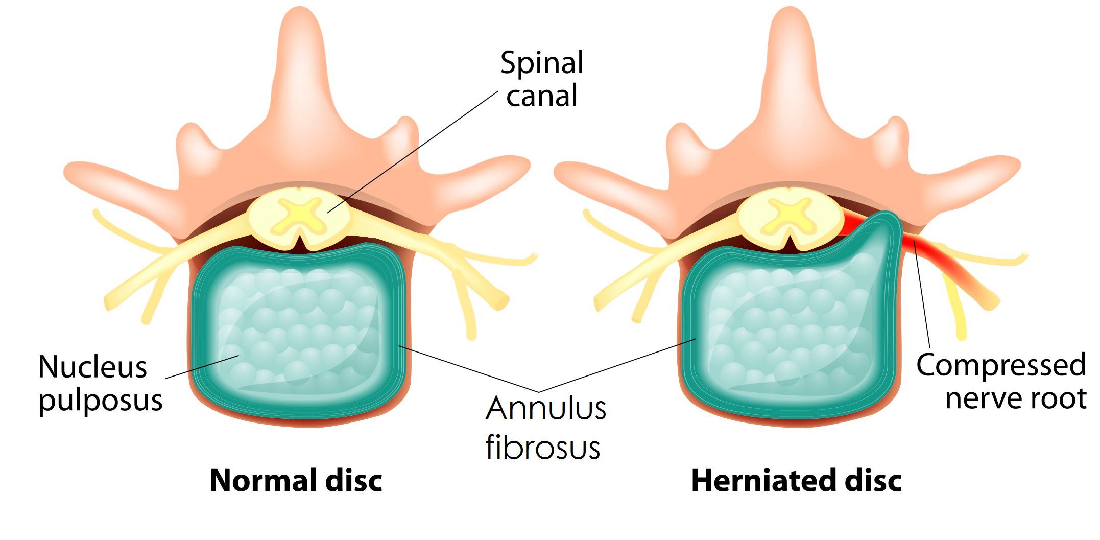 disc herniated sciatica spinal nerve symptoms pain herniation cartilage discs column treatment complications doctors root slipped physio local potential vertebrae