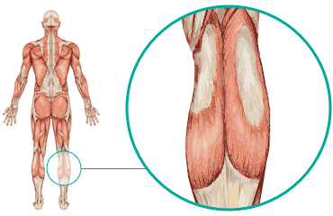 Calf - Causes & Treatments